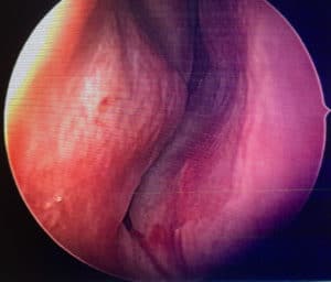 deviated septum 1