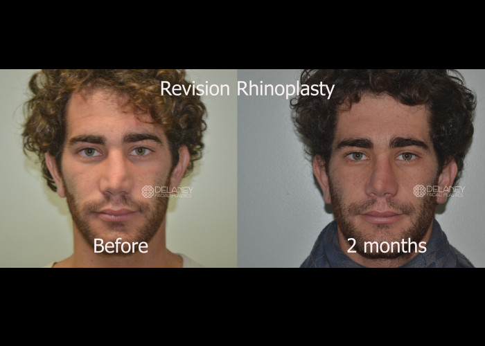 Revision Rhinoplasty