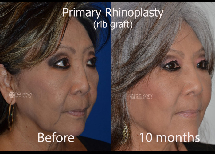 Rib Graft Rhinoplasty