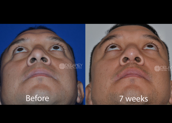 Rib Graft Rhinoplasty