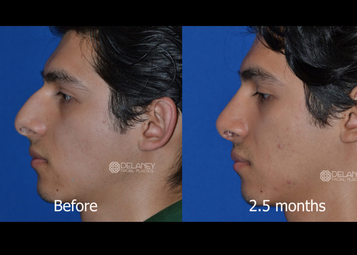 Primary Rhinoplasty