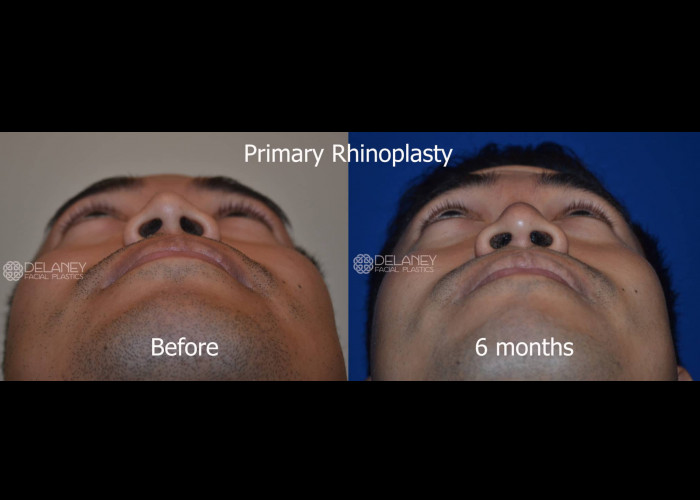 Primary Rhinoplasty