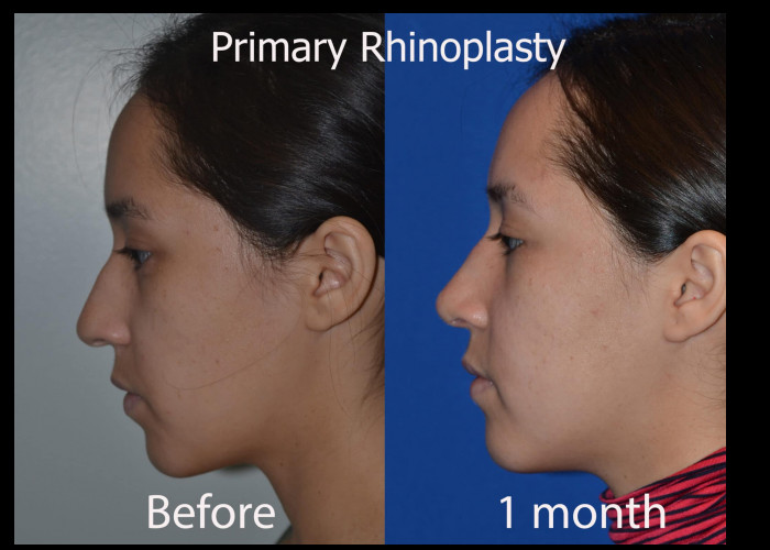 Primary Rhinoplasty