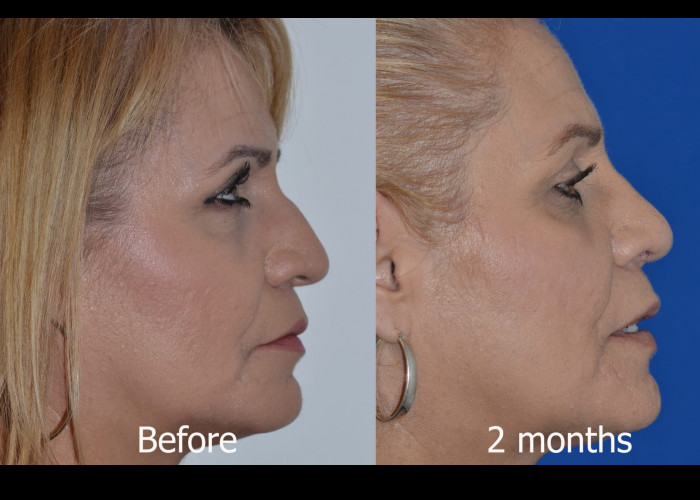 Primary Rhinoplasty with Rib graft