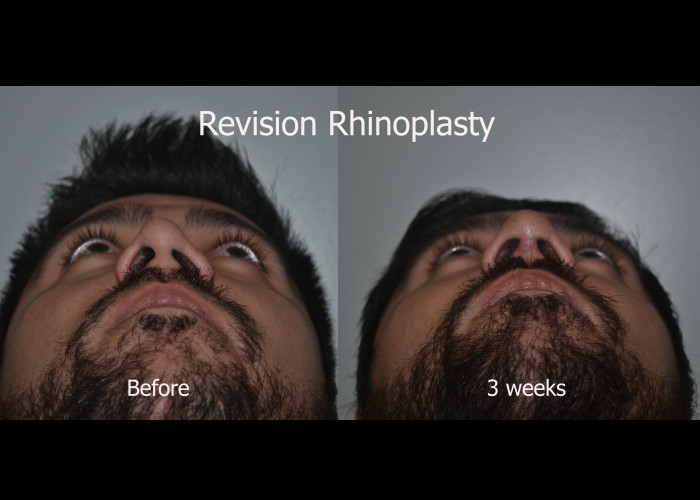 Revision Rhinoplasty, minor