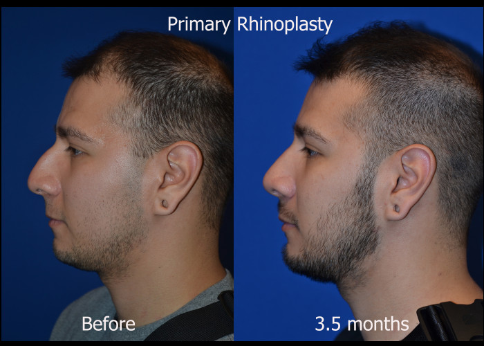 Primary Rhinoplasty