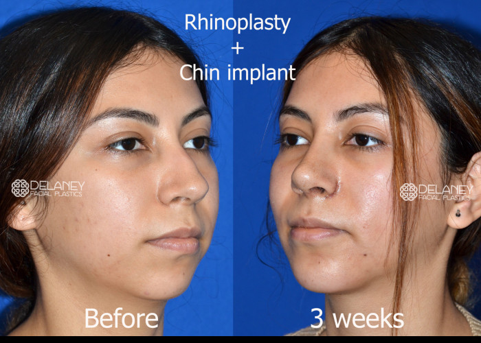 Primary Rhinoplasty + Chin Implant