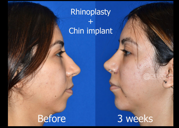 Rhinoplasty Archives - Huntington ENT