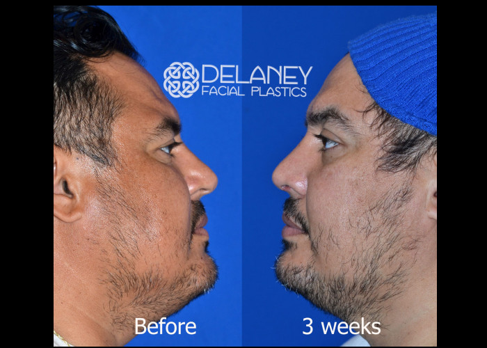 Primary Rhinoplasty