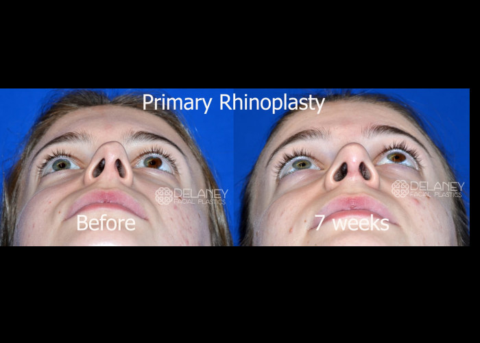 Primary Rhinoplasty