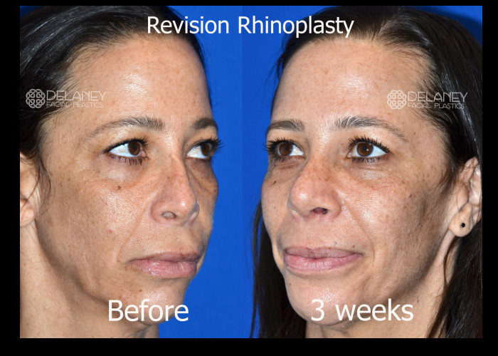 Revision Rhinoplasty
