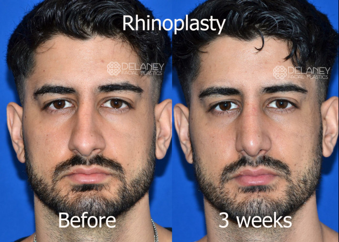 Primary Rhinoplasty