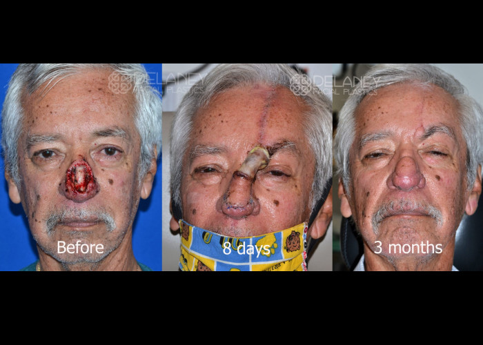Mohs nasal reconstruction