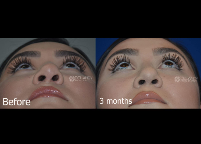 Revision Rhinoplasty