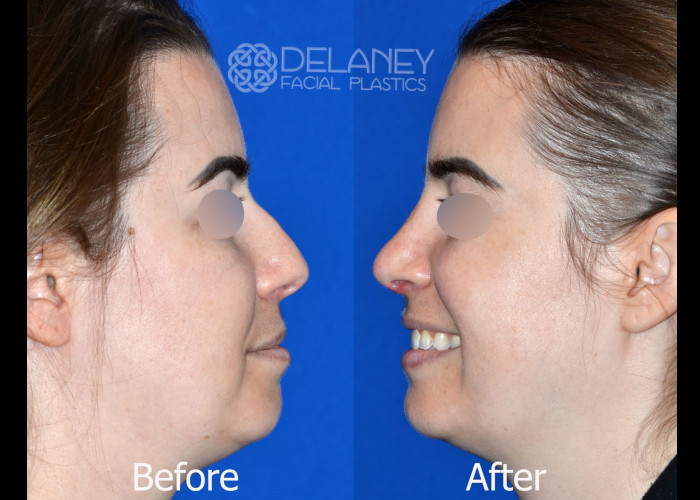 Rhinoplasty - Huntington ENT