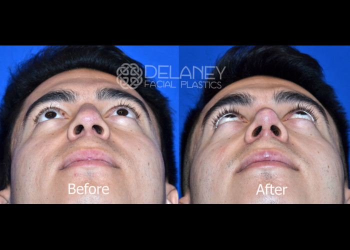 Rhinoplasty