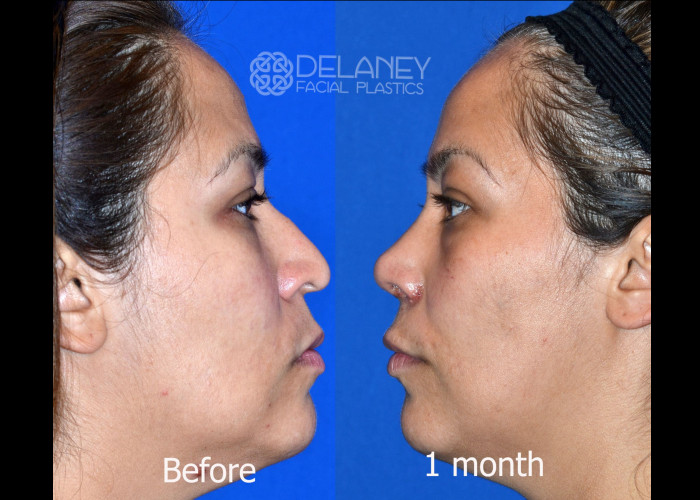 Rhinoplasty - Huntington ENT