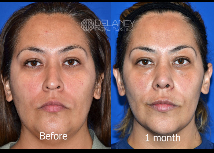 Rhinoplasty